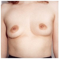 Breast Augmentation before and after - before