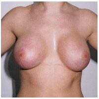 Breast Augmentation before and after - after