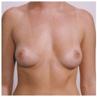 Breast Augmentation before and after - before