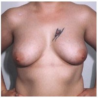 Breast Augmentation before and after - after