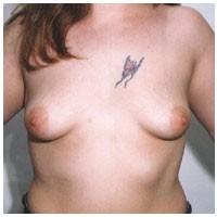 Breast Augmentation before and after - before