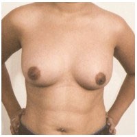 Breast Augmentation before and after - after