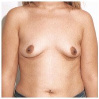 Breast Augmentation before and after - before