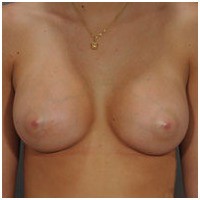 Breast Augmentation before and after - after