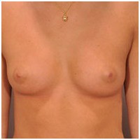 Breast Augmentation before and after - before
