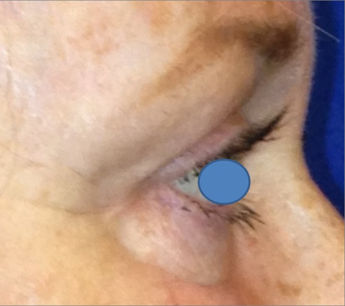 Blepharoplasty before and after - after