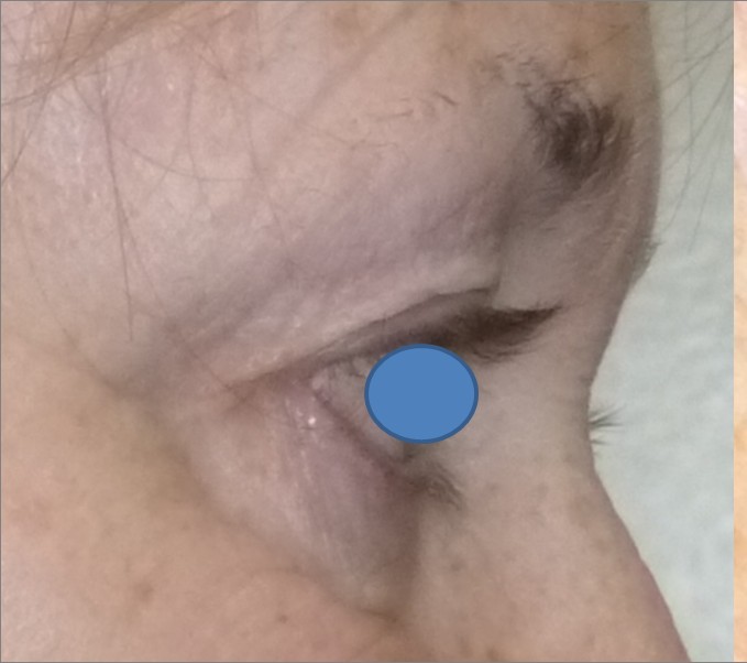 Blepharoplasty before and after - before
