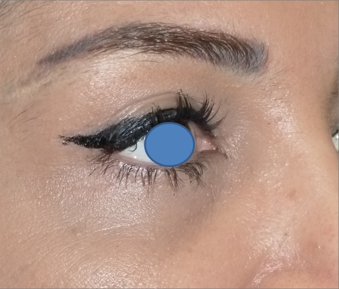 Blepharoplasty before and after - after