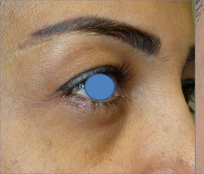 Blepharoplasty before and after - before