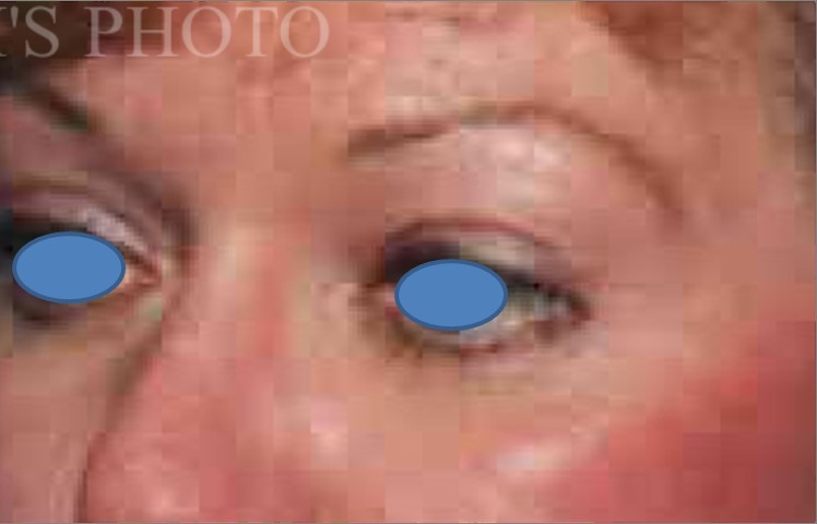 Blepharoplasty before and after - after