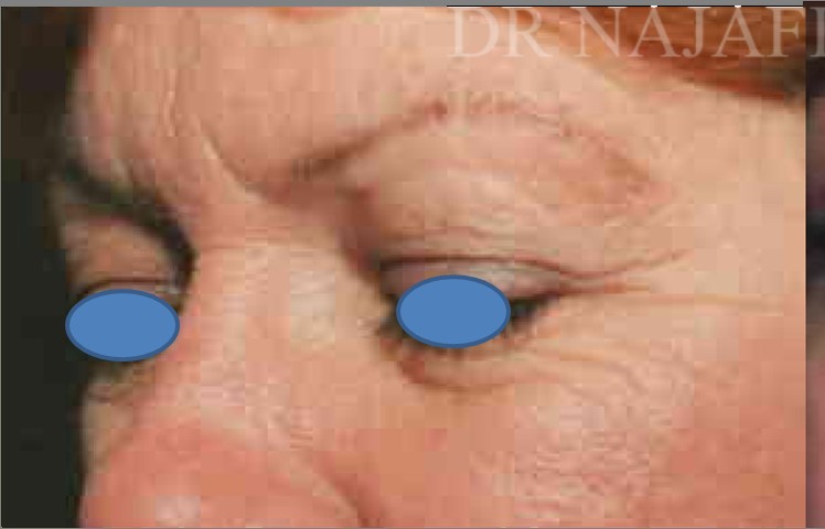 Blepharoplasty before and after - before