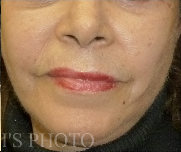 Facelift after — Dr. Hossein Najafi