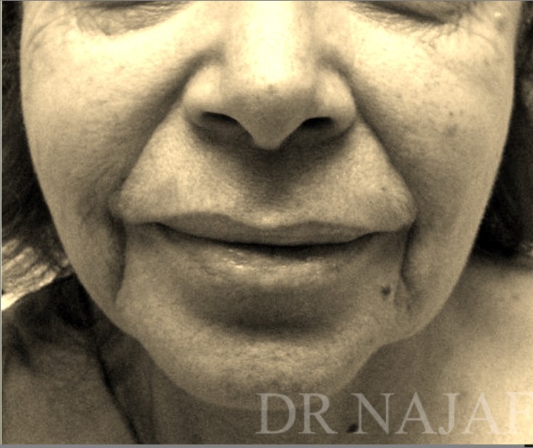 Facelift before — Dr. Hossein Najafi