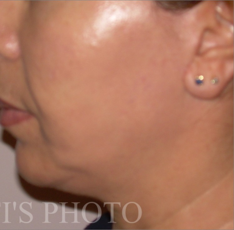 Facelift after — Dr. Hossein Najafi