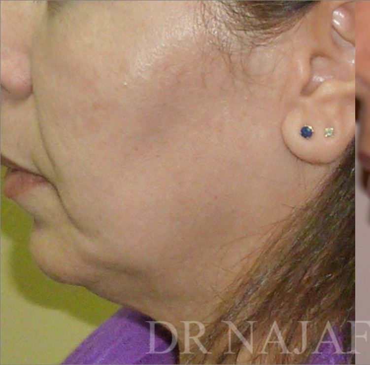 Facelift before — Dr. Hossein Najafi