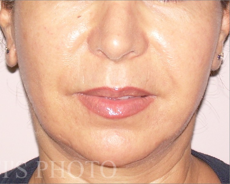 Facelift after — Dr. Hossein Najafi