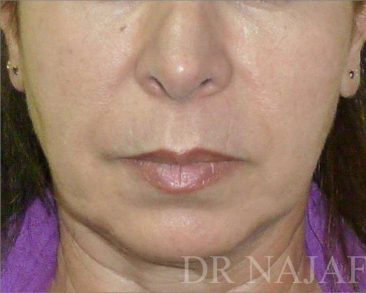 Facelift before — Dr. Hossein Najafi