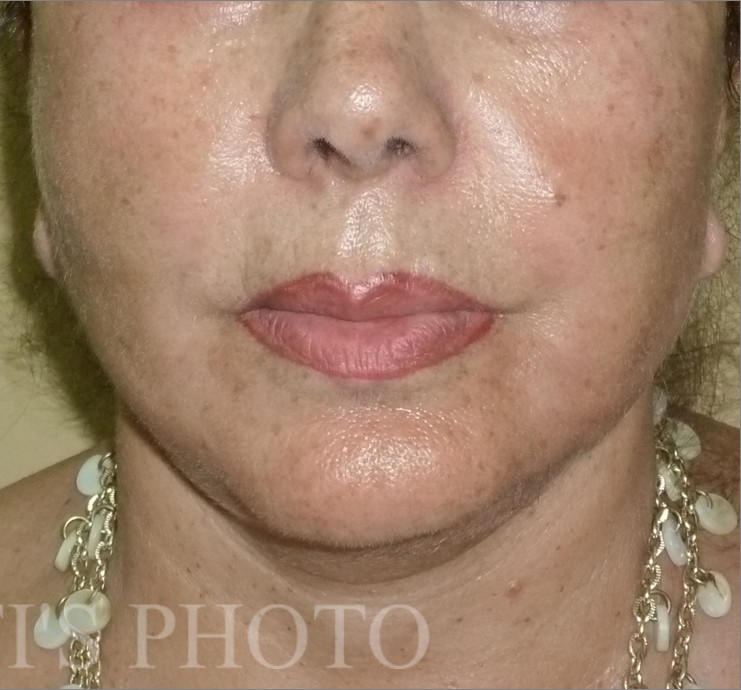 Facelift after — Dr. Hossein Najafi