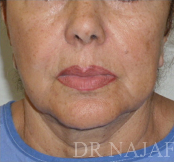 Facelift before — Dr. Hossein Najafi
