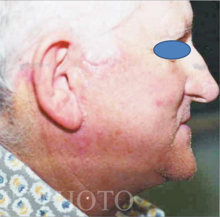 Facelift after — Dr. Hossein Najafi