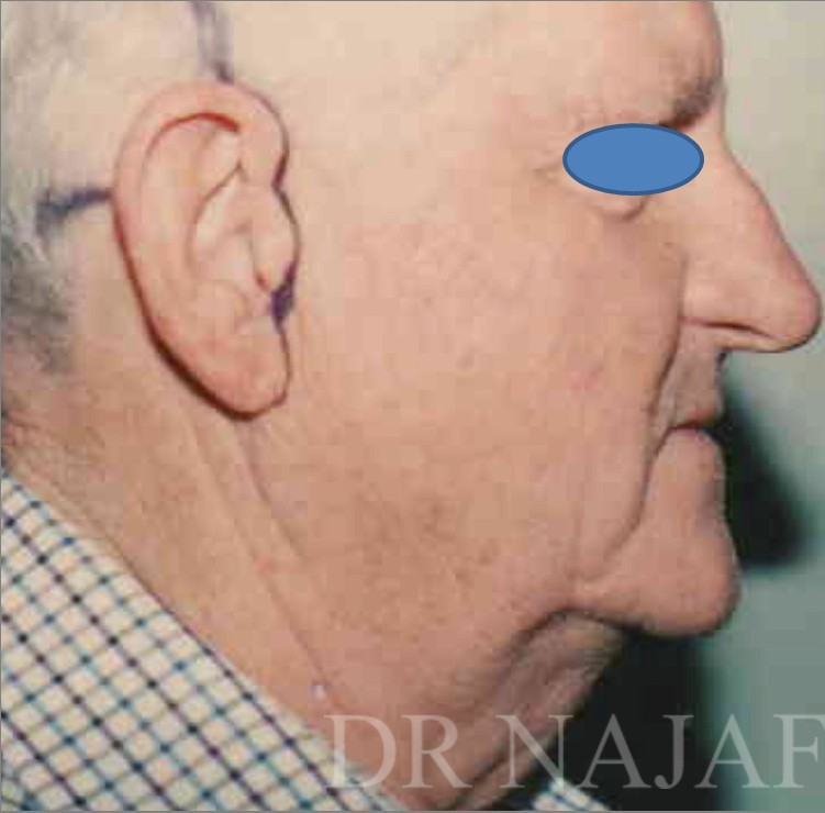 Facelift before — Dr. Hossein Najafi