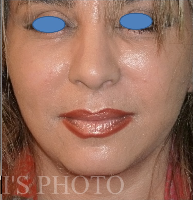 Facelift after — Dr. Hossein Najafi