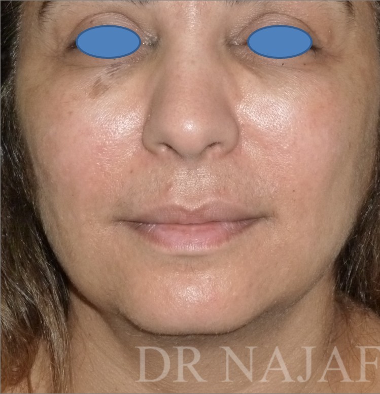 Facelift before — Dr. Hossein Najafi
