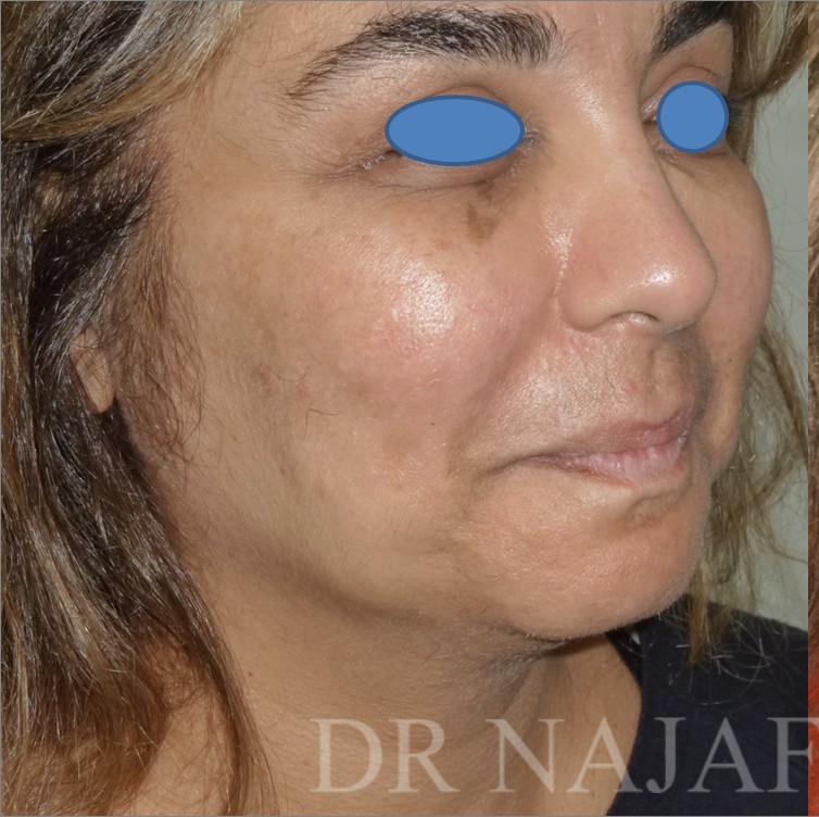 Facelift before — Dr. Hossein Najafi