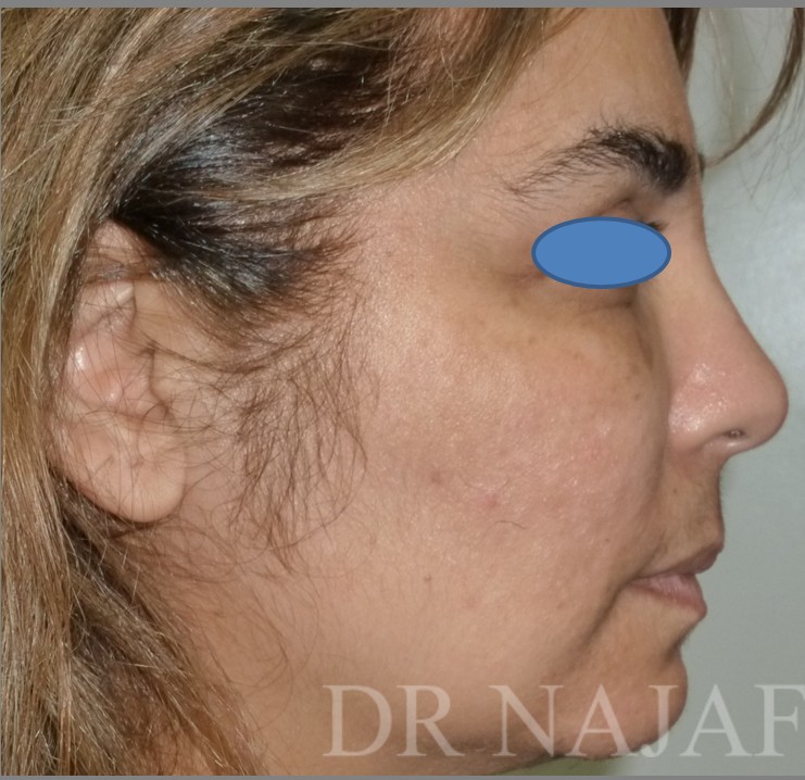 Facelift before — Dr. Hossein Najafi
