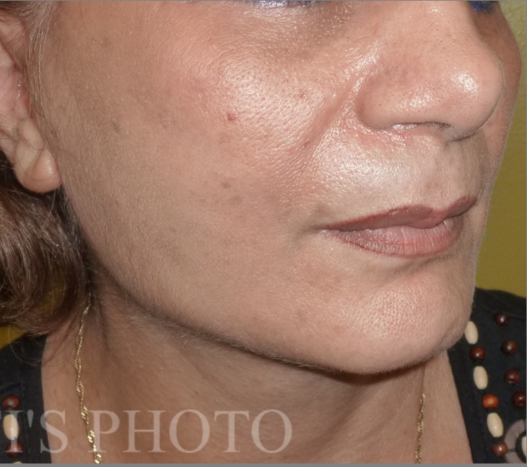 Facelift after — Dr. Hossein Najafi