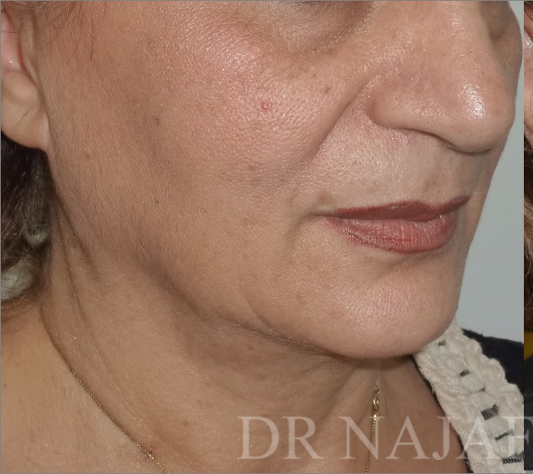 Facelift before — Dr. Hossein Najafi
