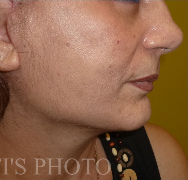Facelift after — Dr. Hossein Najafi