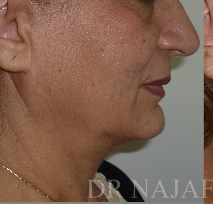 Facelift before — Dr. Hossein Najafi