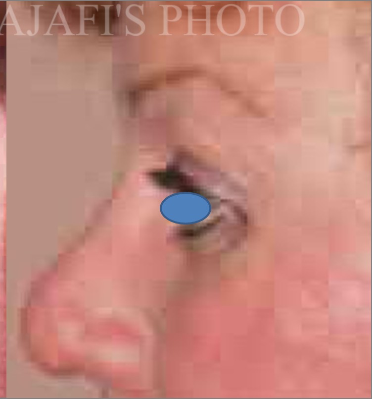 Blepharoplasty before and after - after