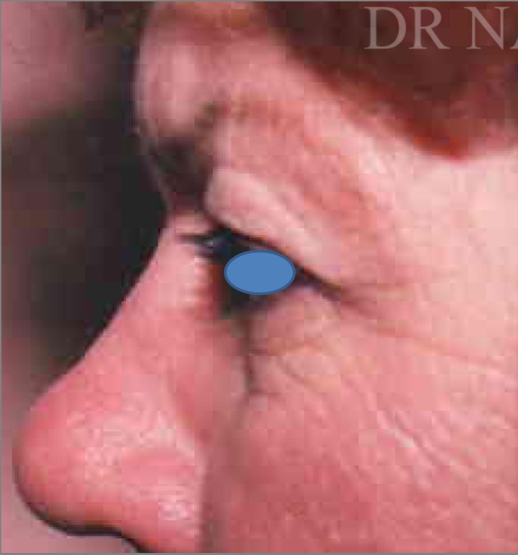 Blepharoplasty before and after - before