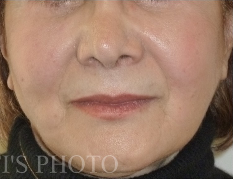 Facelift after — Dr. Hossein Najafi