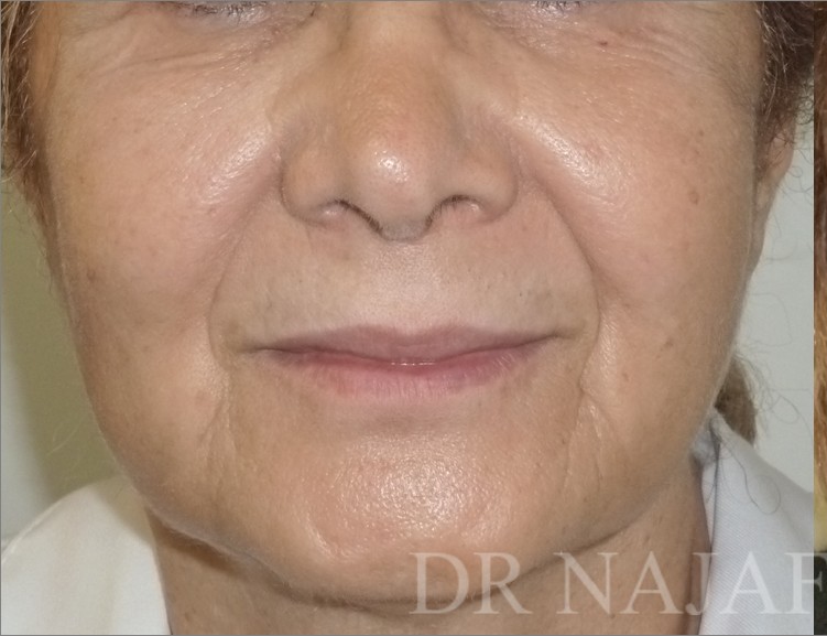 Facelift before — Dr. Hossein Najafi