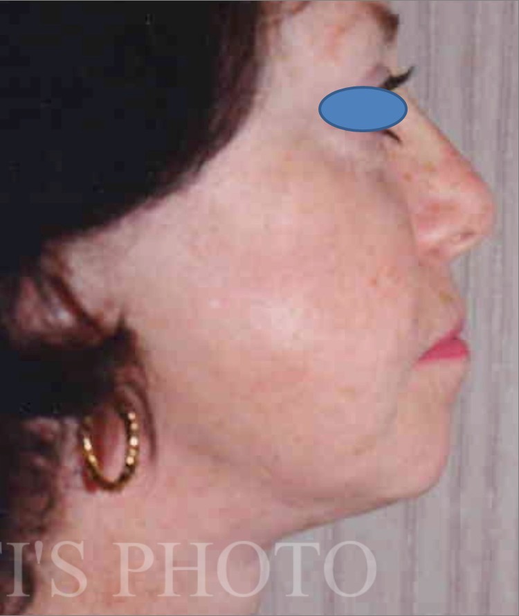 Facelift after — Dr. Hossein Najafi