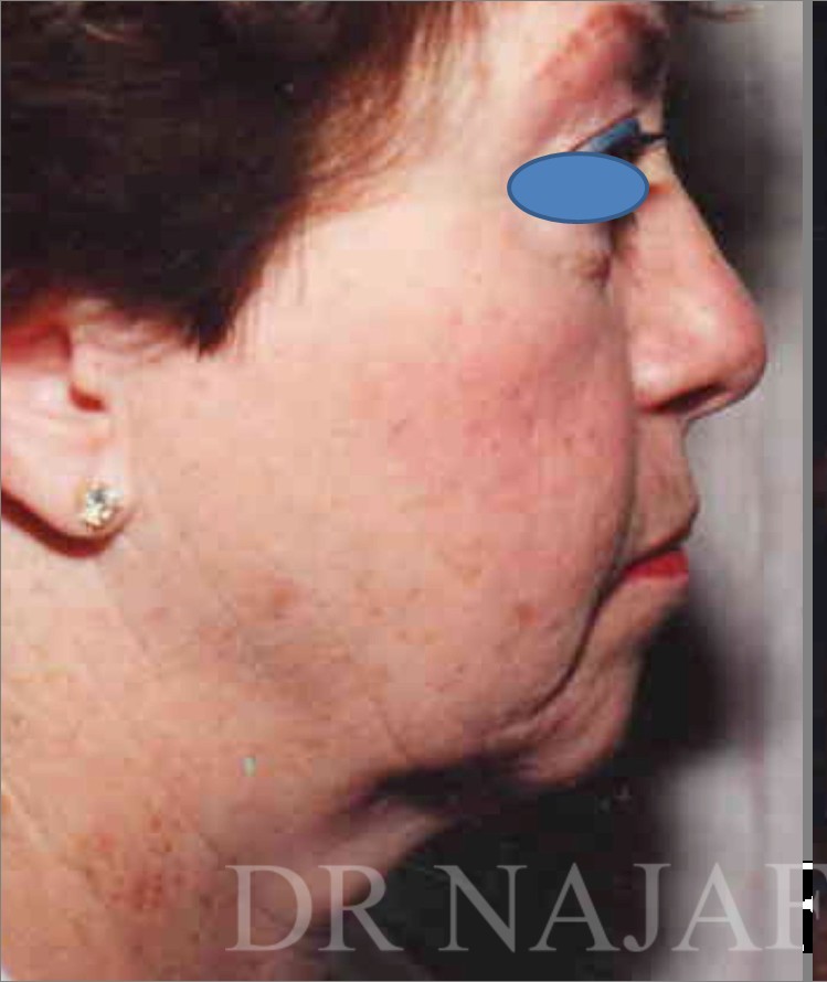 Facelift before — Dr. Hossein Najafi