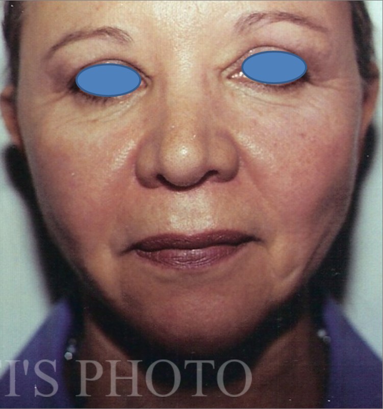Facelift after — Dr. Hossein Najafi