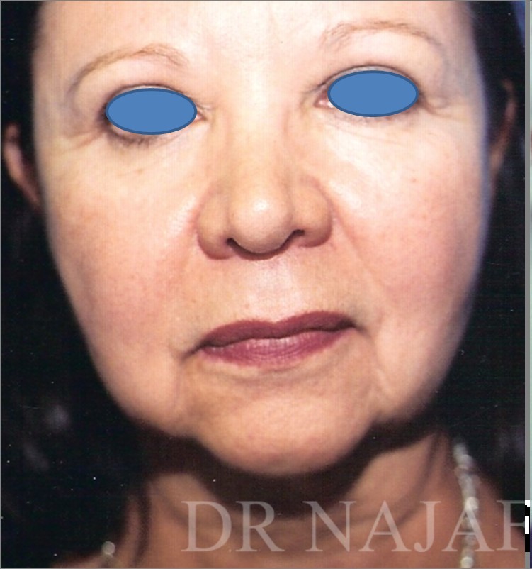 Facelift before — Dr. Hossein Najafi