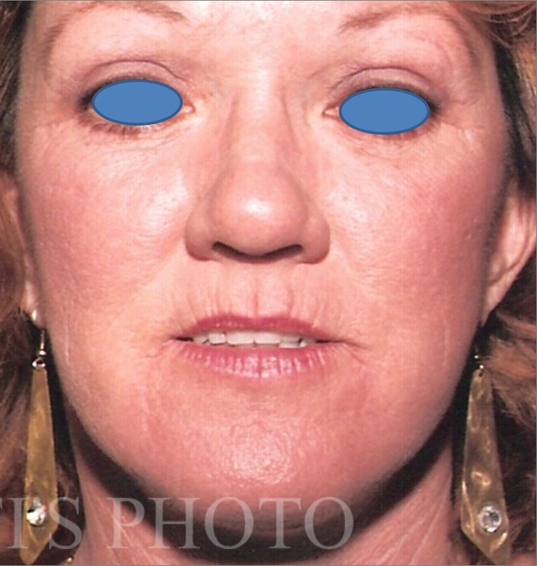 Facelift after — Dr. Hossein Najafi