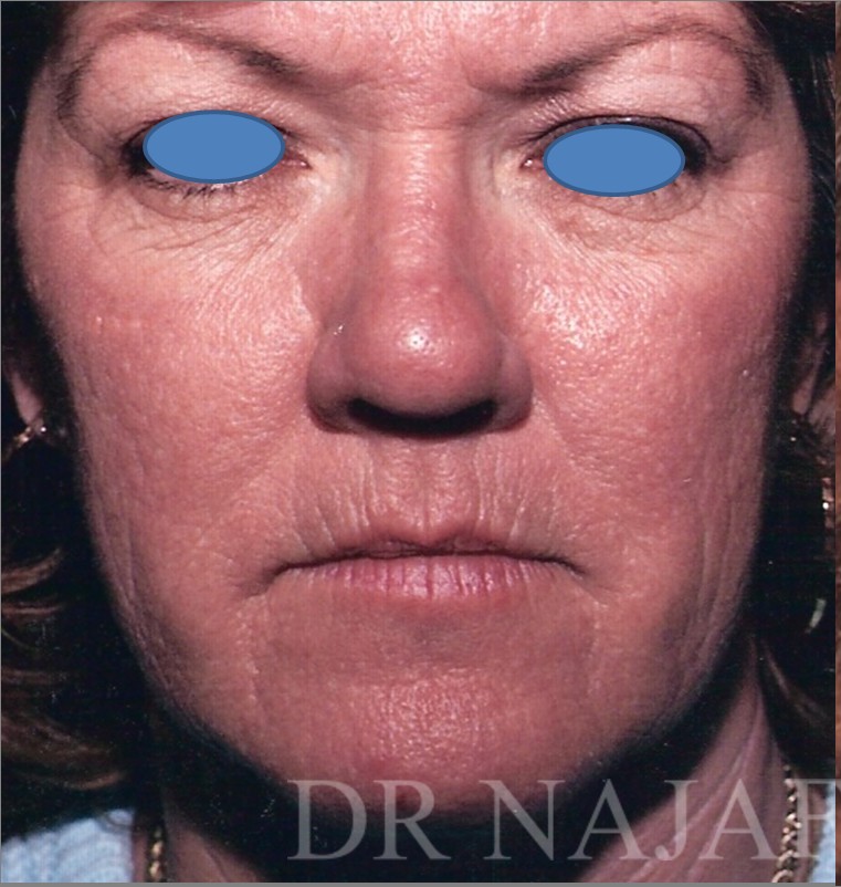 Facelift before — Dr. Hossein Najafi