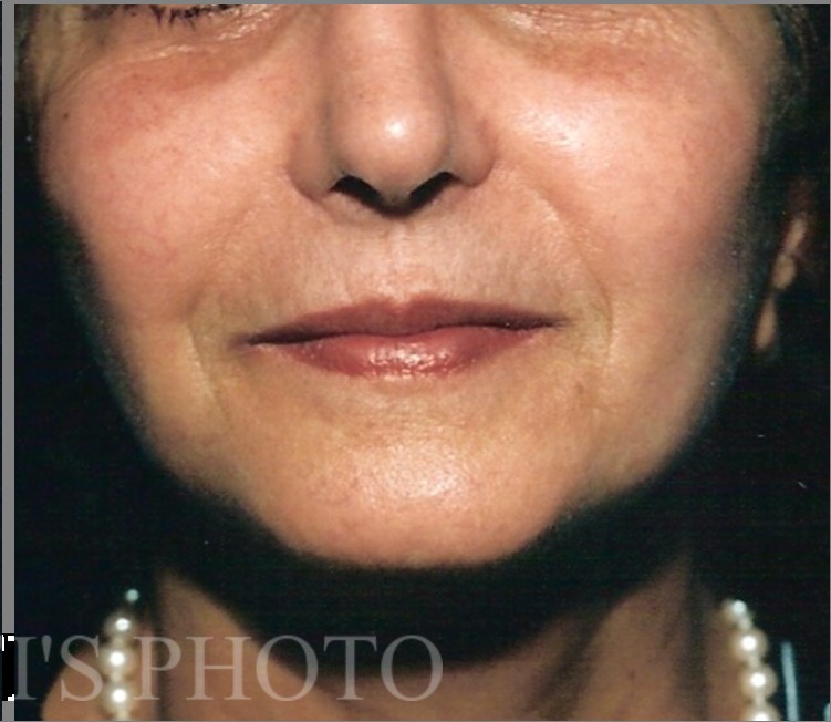 Facelift after — Dr. Hossein Najafi