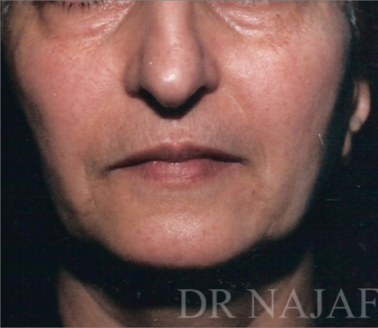 Facelift before — Dr. Hossein Najafi