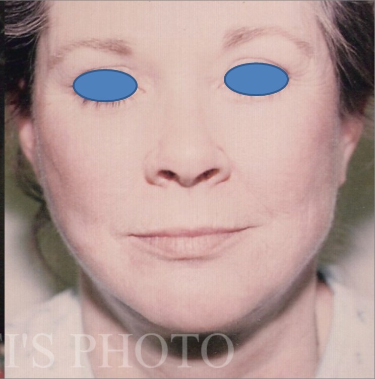 Facelift after — Dr. Hossein Najafi