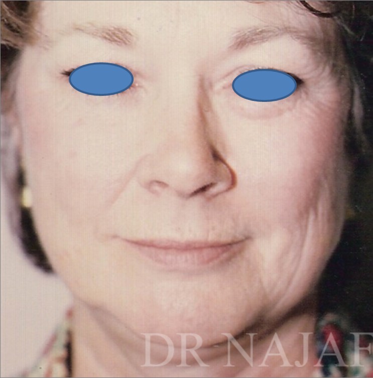 Facelift before — Dr. Hossein Najafi