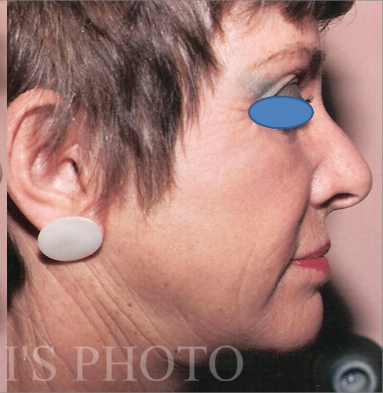 Facelift before and after - after