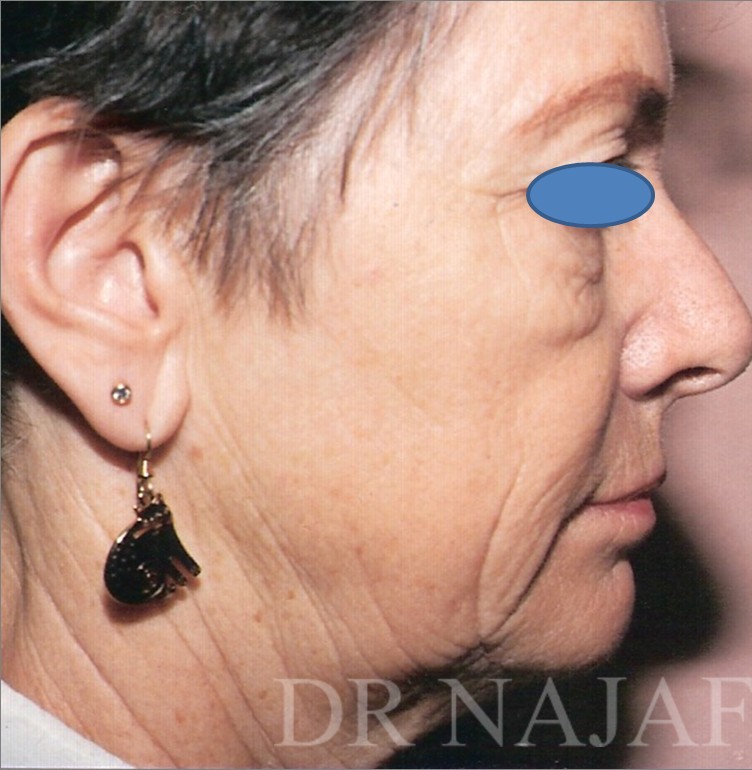 Facelift before and after - before