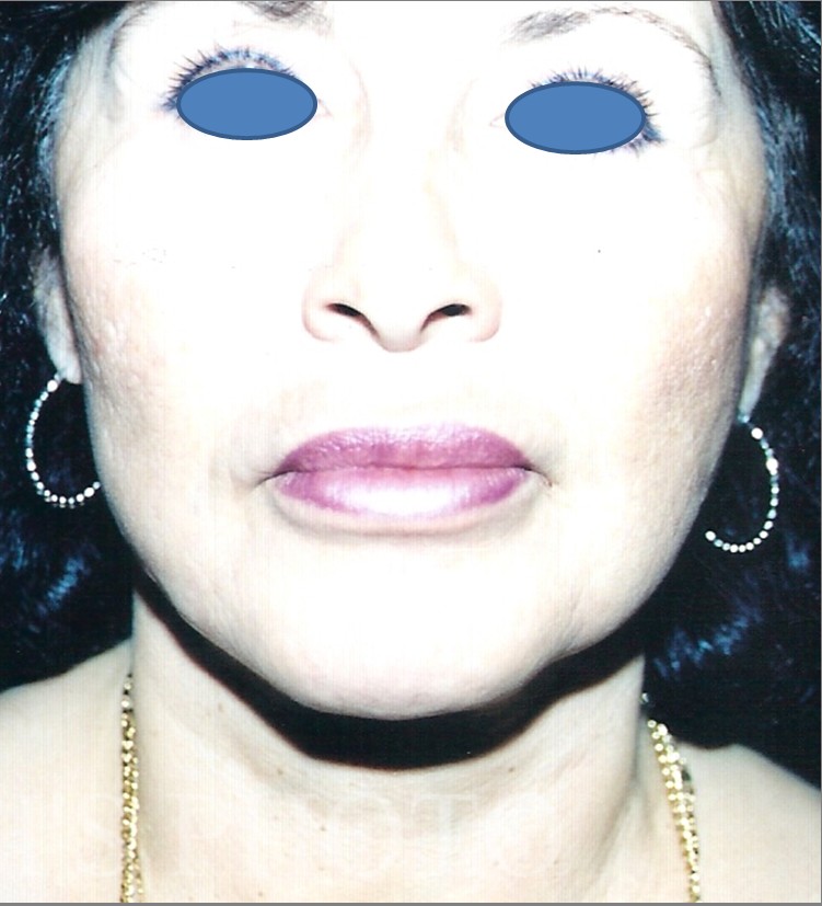 Facelift before and after - after